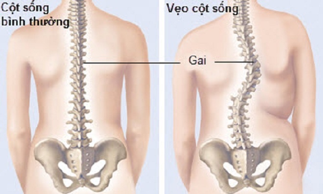 dấu hiệu bệnh gù vẹo cột sống